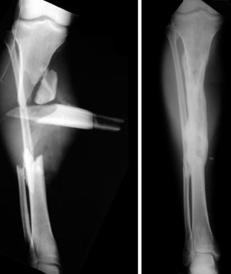At left, an X-ray of an open tibia (shin bone) fracture.  On the right, the same patient one year later after successful treatment.