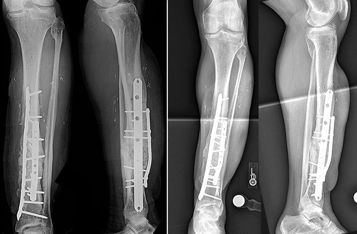 X-rays at three and 12 months after surgery