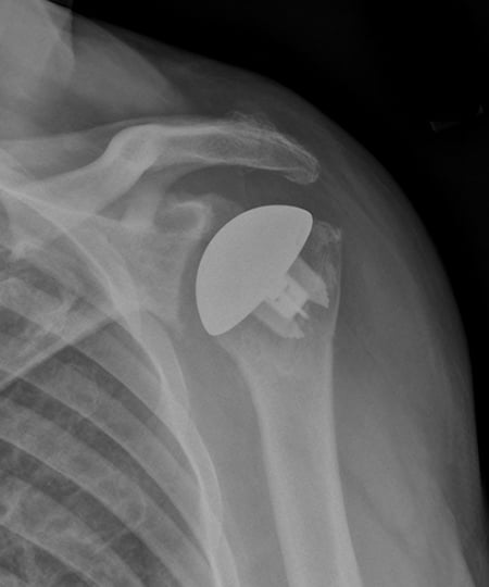 X-ray of an anatomic total shoulder replacement with a modern, stemless implant.
