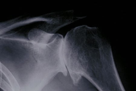 X-ray showing osteoarthritis of the shoulder joint, in which bones of the joint are in direct contact due to cartilage being worn down