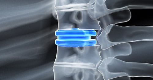 Computer illustration of disc replacement.