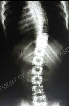 Scoliosis X-ray.