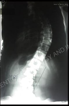 Scoliosis X-ray.