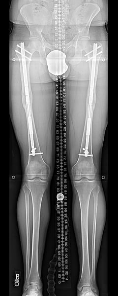 Femurs at end of consolidation