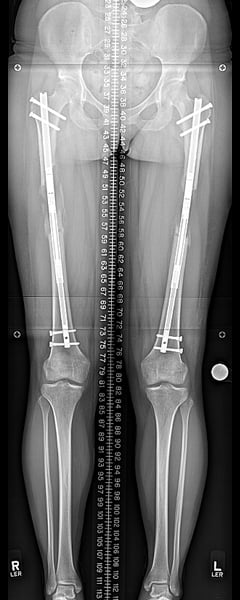 Femurs at end of distraction