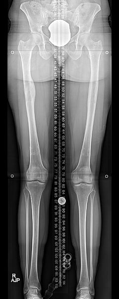 Femurs with nails removed