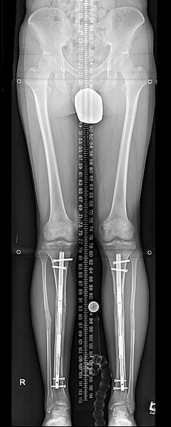 Tibia at end of consolidation