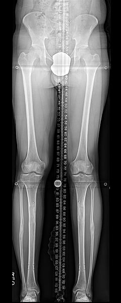 Tibias with nails removed