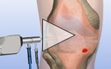Video icon for the inflamed synovial tissue removal animation