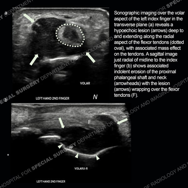 Two stacked sonographic images of left index finger - Ultrasound Case 186