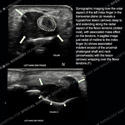 Two stacked sonographic images of left index finger for case 185