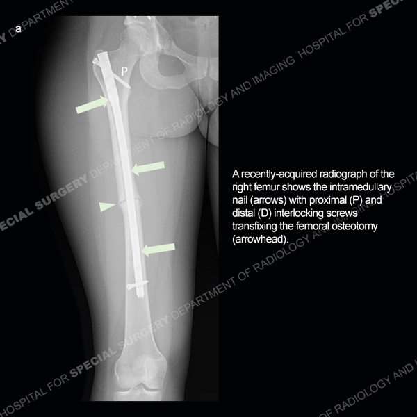 Radiograph of the right femur showing intramedullary nail - Ultrasound Case 188