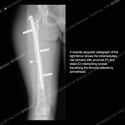 Ultrasound thumbnail image of case 188 - Radiograph of the right femur showing intramedullary nail