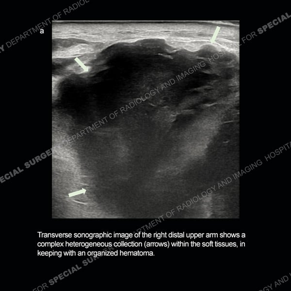 Transverse sonographic image of the right distal upper arm