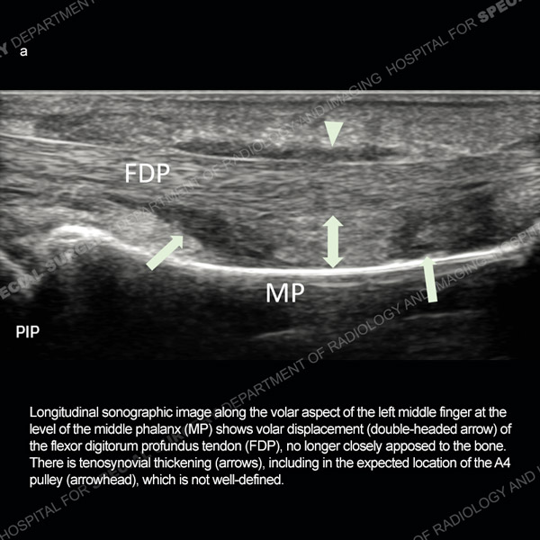 Sonographic image along the volar aspect of the left middle finger Case 190