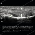Ultrasound thumbnail image of case 190 - longitudinal sonographic image along the volar aspect of the left middle finger
