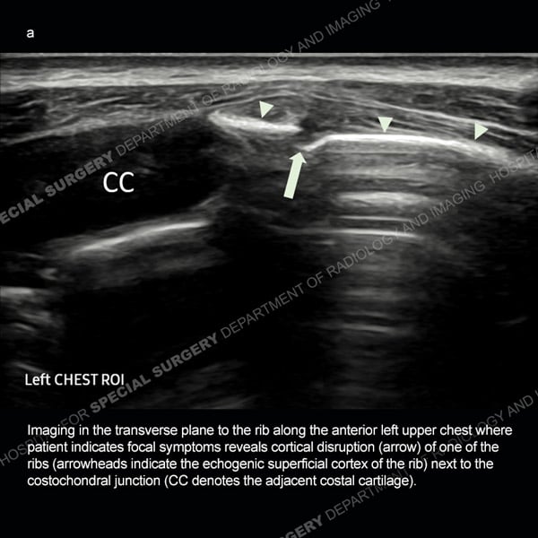 Ultrasound image in the transverse plane to the rib along the anterior left upper chest