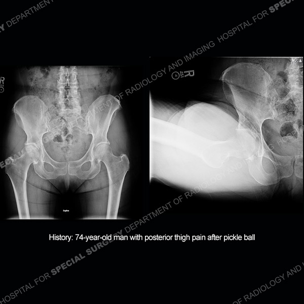 Radiograph images of thigh area for Case 217