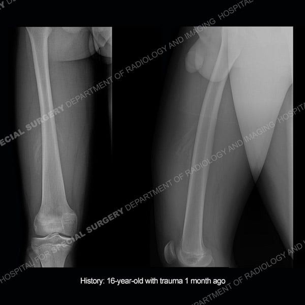 Radiograph image of right femoral bone for Case 218