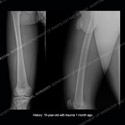 Radiograph image of right femoral bone for Case 218