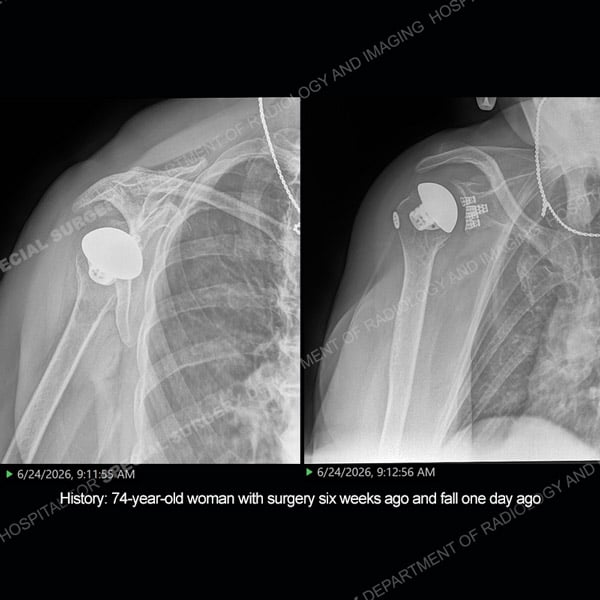 Side by side radiograph images of shoulder arthroplasty Case 219