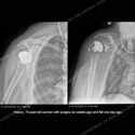 Side by side radiograph images of shoulder arthroplasty Case 219