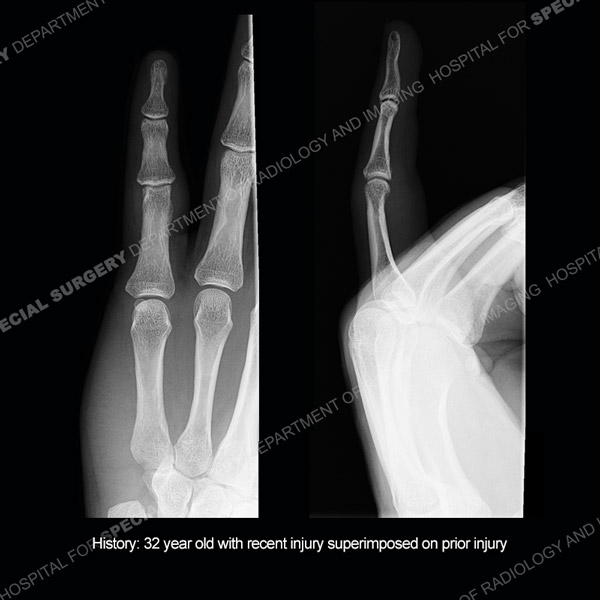 Side by side radiograph images of finger Case 220