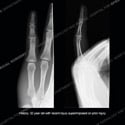 Side by side radiograph images of finger Case 220