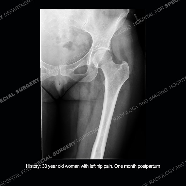 Radiograph image of left hip Case 222
