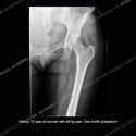 Radiograph of left hip Case 222