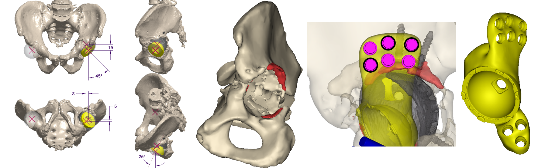 The Device Development team works with the surgeon and outside manufacturers to develop a patient-specific flanged acetabular component to treat the patient’s unique defect.
