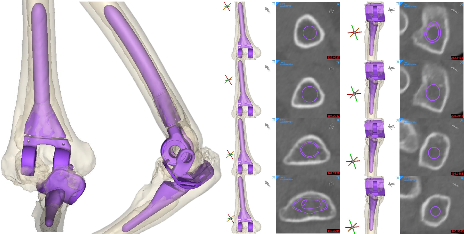 Initial fit check of standard TEA component was done by the device development engineers. Both humeral and ulnar components were too small for a cementless TEA.  Patient specific implants were needed.