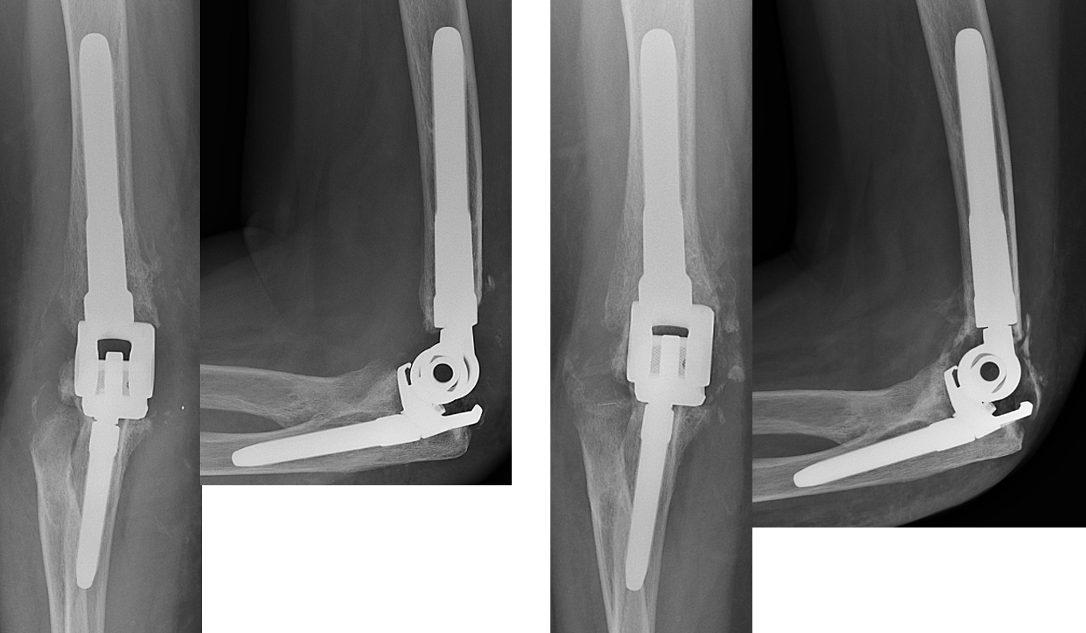 Immediate post-op x-rays (left) and 3-month post-op x-rays (right) showing well-fixed implants and bone ingrowth.   