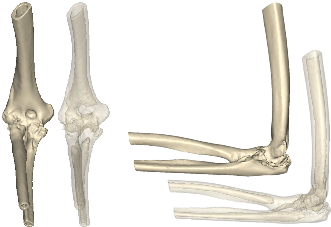 X-rays showing a right elbow of a patient with rheumatoid arthritis. Surgeon would like to perform cementless total elbow arthroplasty (TEA) on the patient.