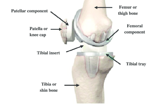 components of Exactech knee replacement