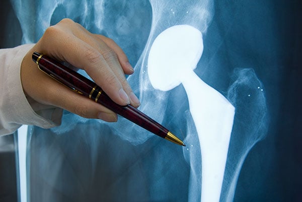 implant-xray