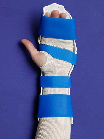 Image of left hand with orthosis top view