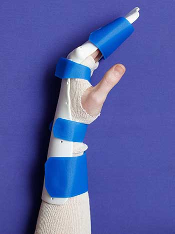 Image of left hand with orthosis side view, thumb side up