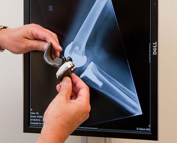 implant-xray