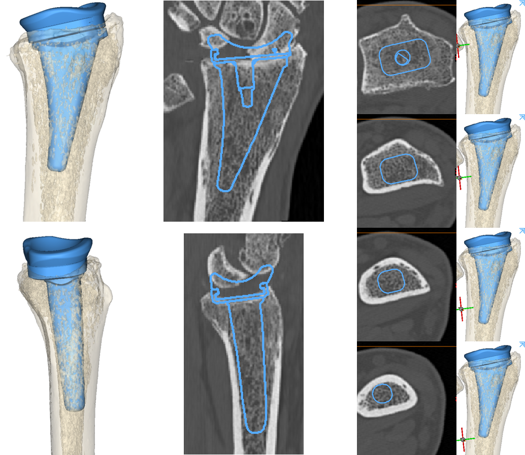 The Device Development team creates 3D reconstructions of the bone to template the size and position of the radial component of the TWA (blue).
