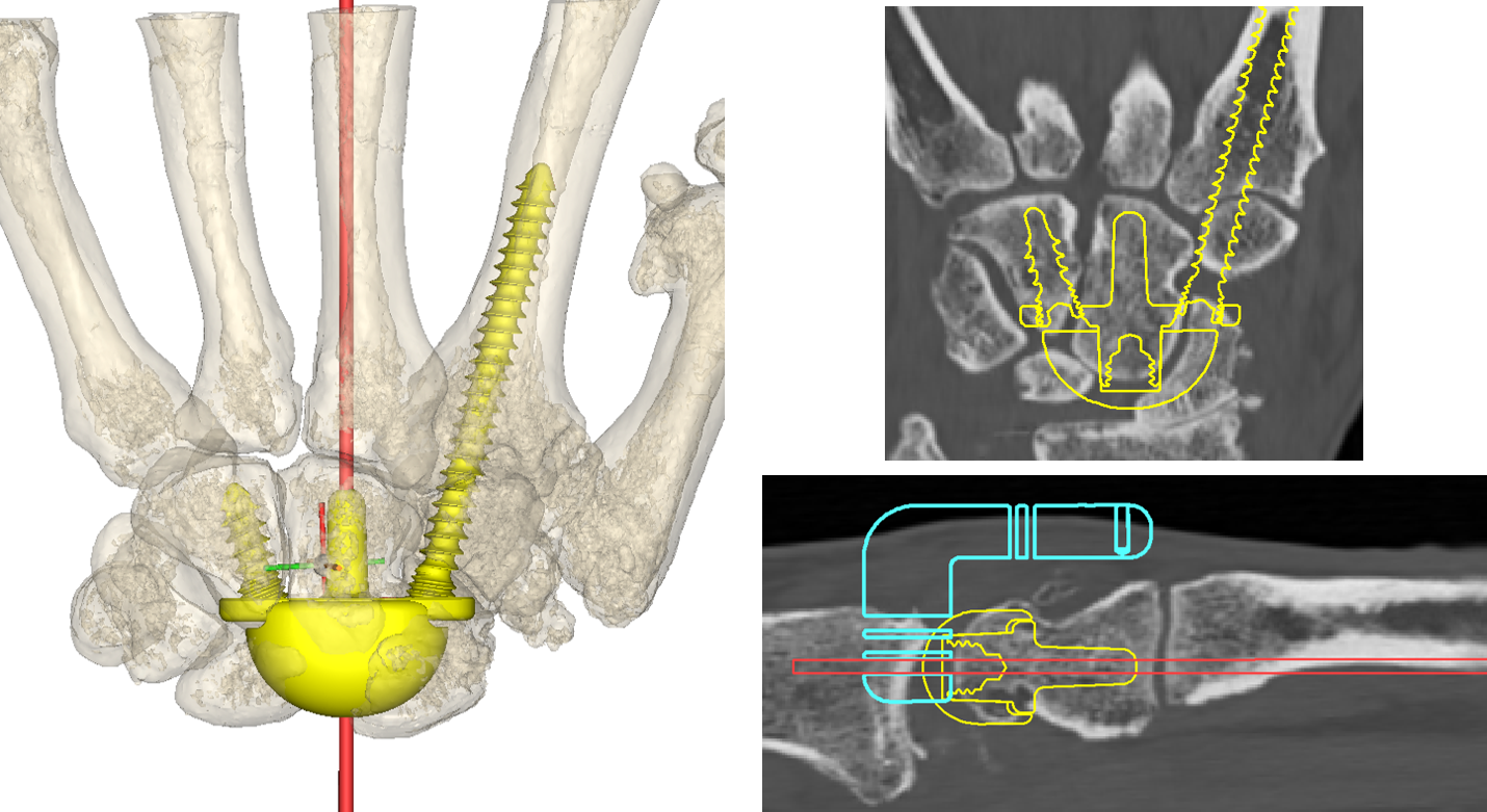 The carpal component of the TWA (yellow) is also templated for size and position.