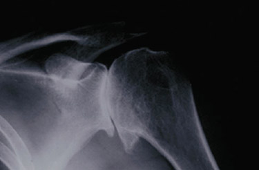 xray of shoulder