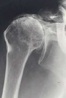 xray of shoulder