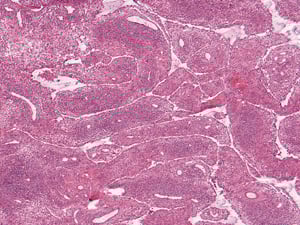Grade 3 (Band): These widespread perivascular aggregates with dense interstitial inflammation extend between adjacent perivascular regions in a band-like manner.