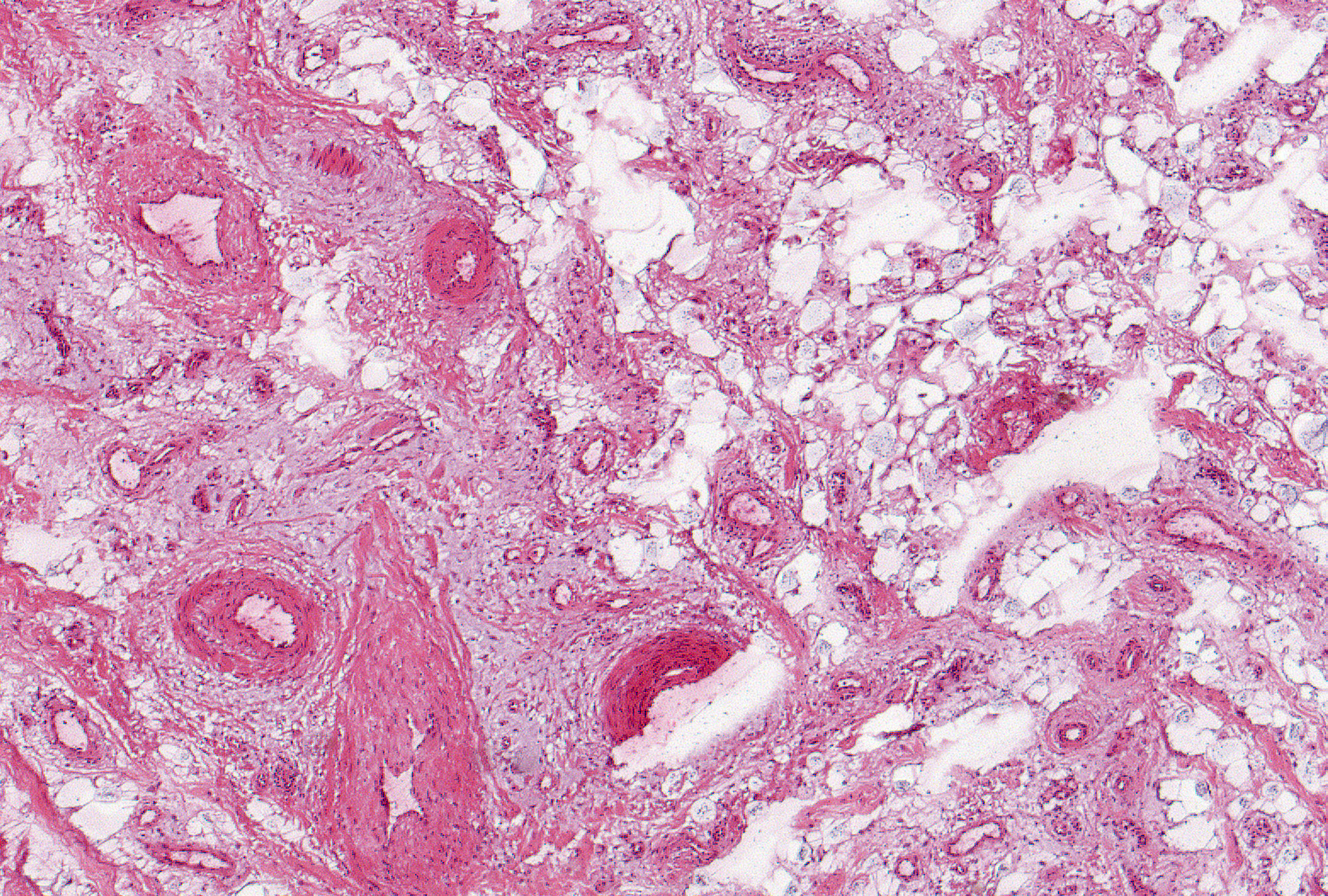 Grade 2: With an increase in mucoid change, there is persisting perivascular accumulation that extends into the adjacent tissues in a patchy distribution.