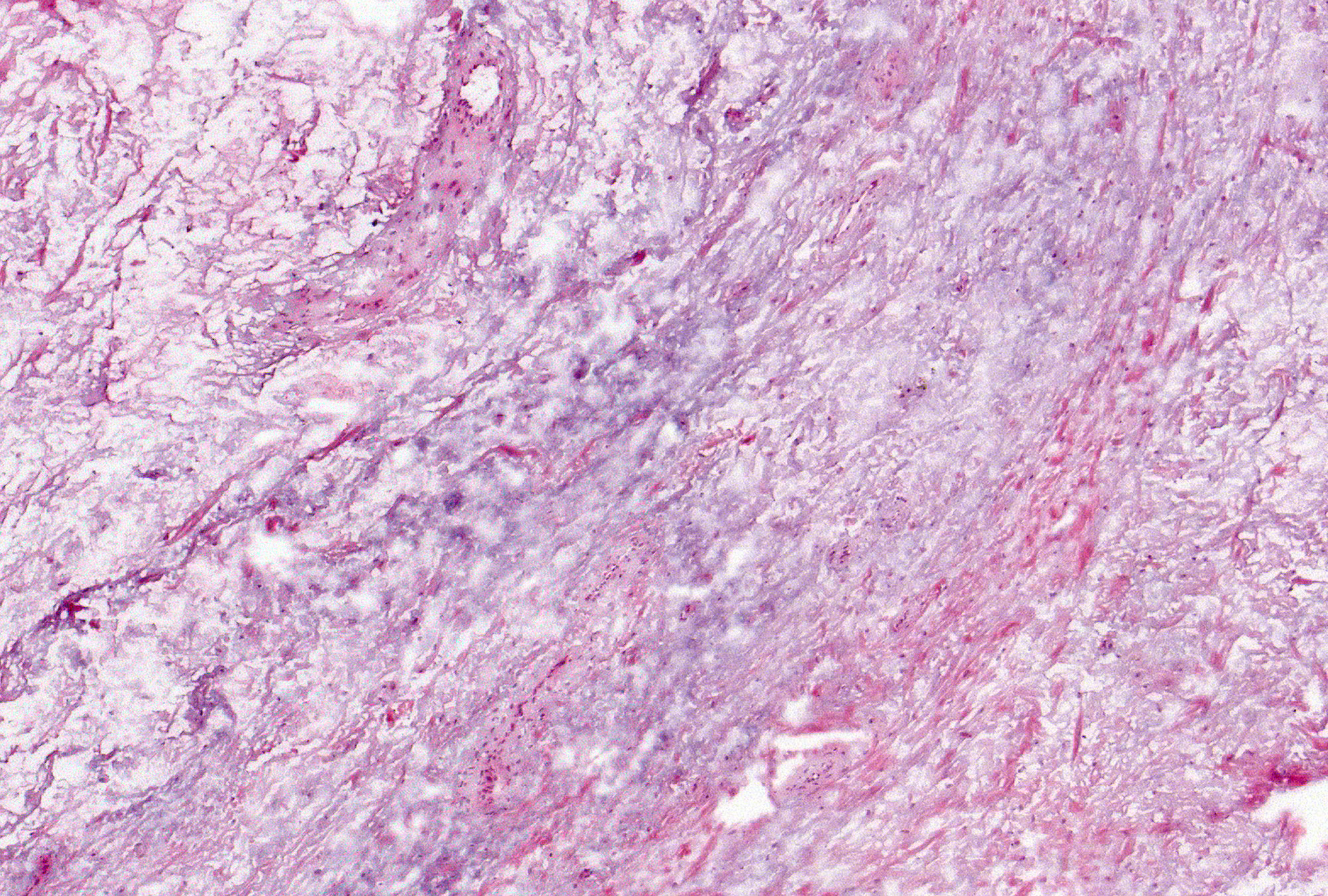 Grade 4: Myxomatous mucoid change appears as a field of material that obliterates the synovial architecture and appears as cells (sometimes angular and stellate) suspended in amorphous, bluish matrix supported by delicate collagenous (pink) stroma. This imparts a jelly-like quality to the gross tissue.