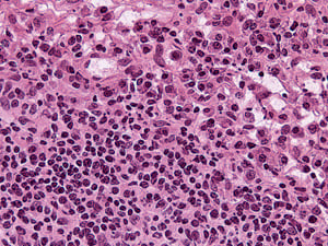 Grade 0: The cells are mostly small lymphocytes with a few plasma cells at the periphery, seen best at the top right edge.