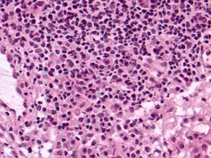 Grade 1: Example B: Plasma cells, especially in the lower left of this image, make up nearly half of the lymphoid cells in this collection.