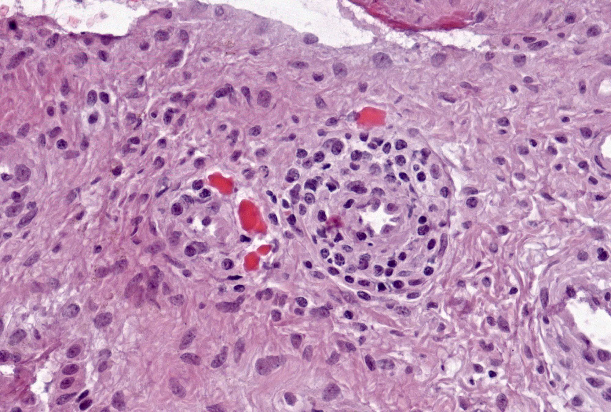 Grade 1: (present), Example 2: Russell bodies may be seen as red irregularly shaped structures or beads free in the tissue.