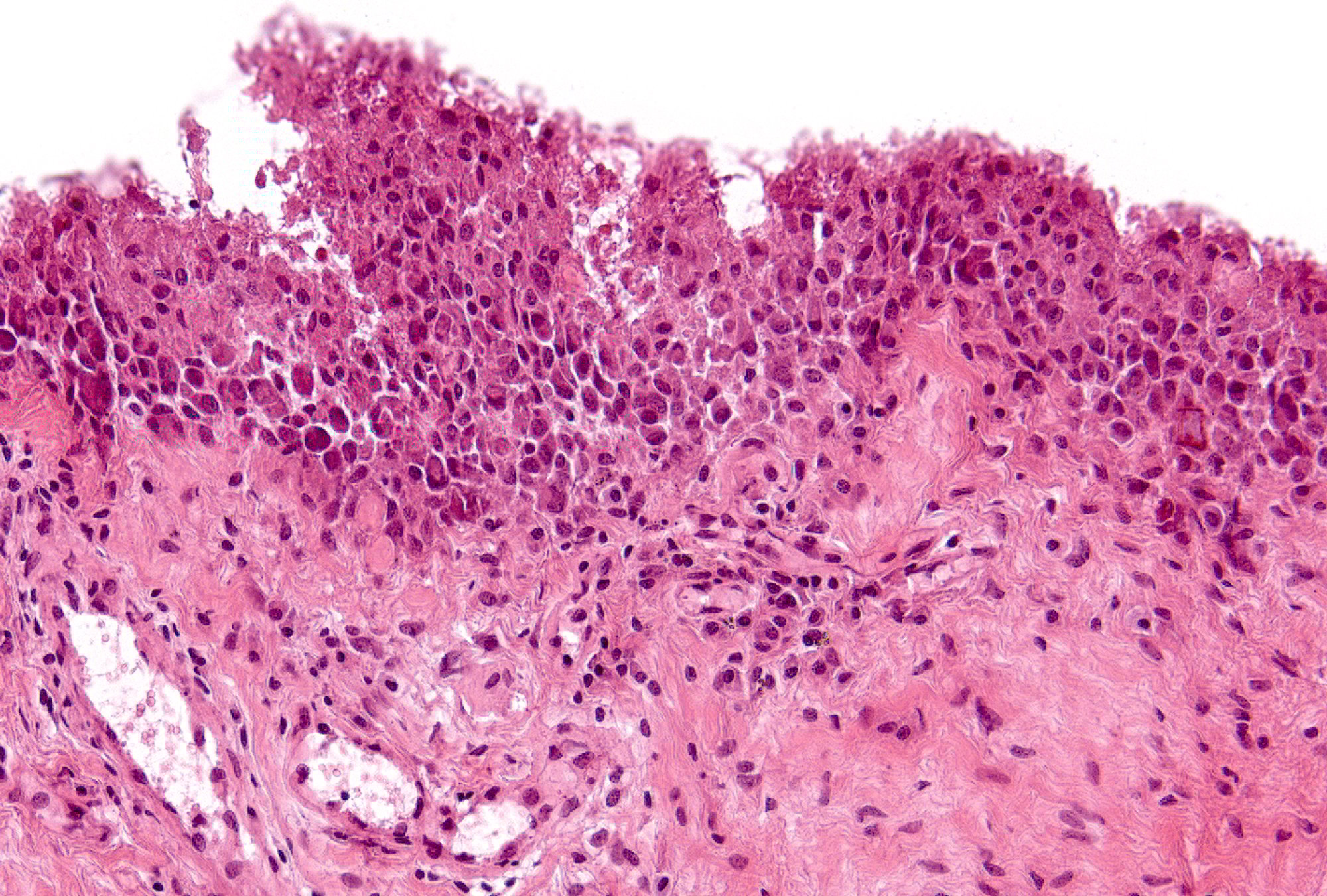 Grade 3 Example 2: The lining layer in this field is remarkably thick due to tangential sectioning which results in the appearance of sheets of synovial lining cells instead of a discernible layer. Due to angle of sectioning, it is possible to make a layer look thicker than it is, but not thinner.